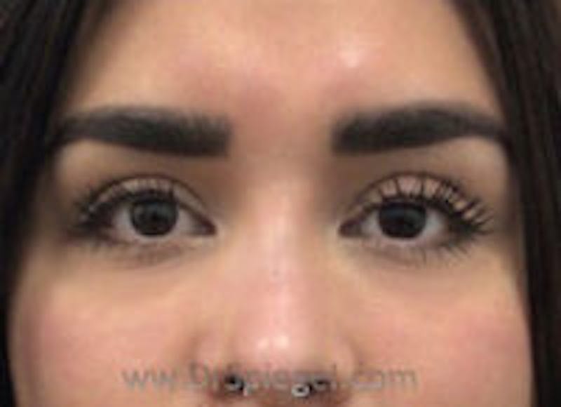 Tear Trough / Under Eye Fillers Before & After Gallery - Patient 157140542 - Image 2