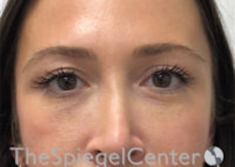Temple Filler Before & After Gallery - Patient 157140538 - Image 2