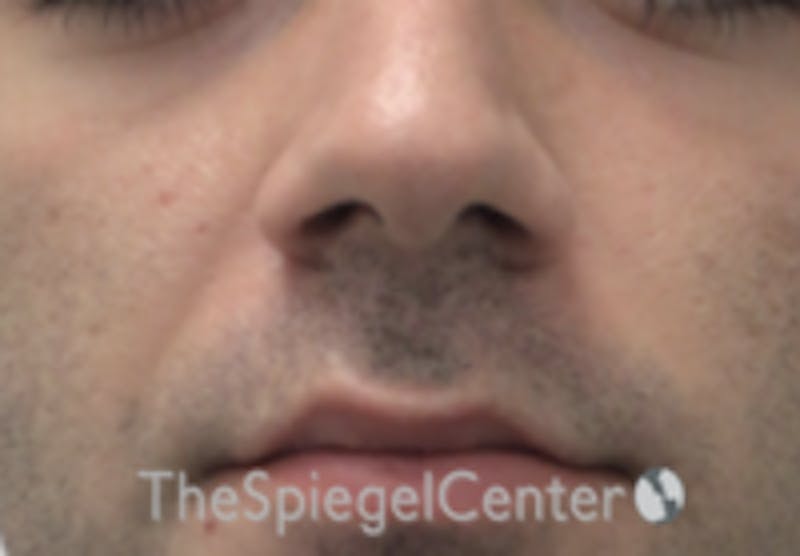 Nasolabial Fold Filler Before & After Gallery - Patient 157140546 - Image 1