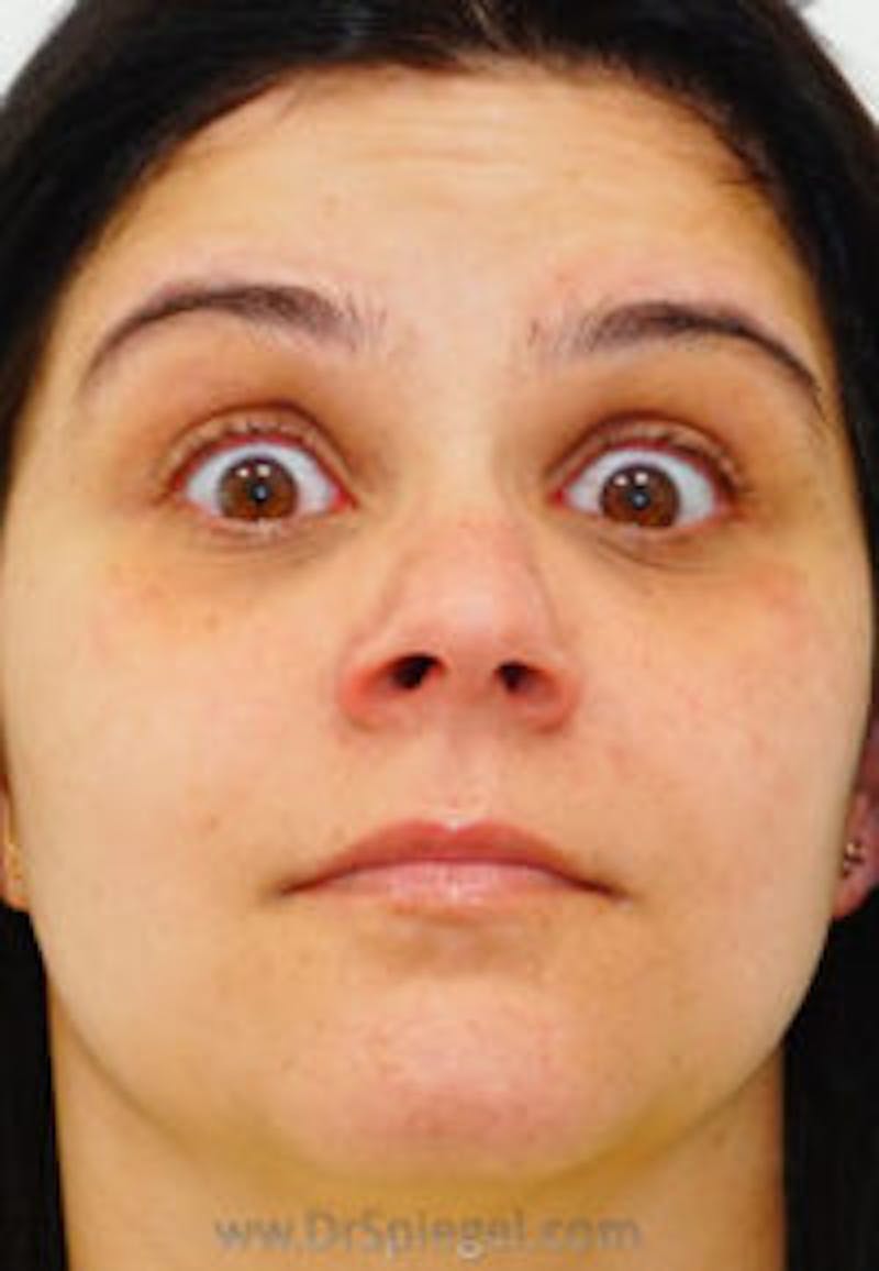 Botox / Dysport / Jeuveau / Xeomin Before & After Gallery - Patient 157140540 - Image 3