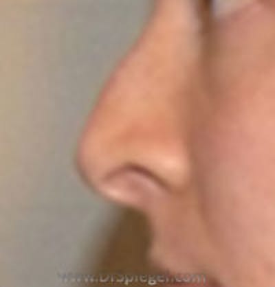 Rhinoplasty Before & After Gallery - Patient 157140539 - Image 1