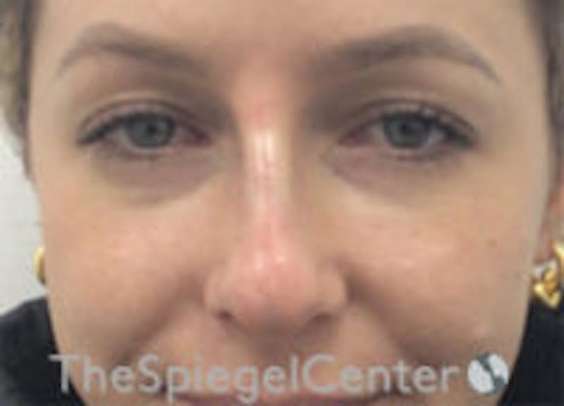 Non-Surgical Rhinoplasty / Nose Filler Before & After Gallery - Patient 157140545 - Image 2