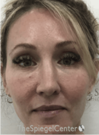 Morpheus8 Before & After Gallery - Patient 157140549 - Image 1