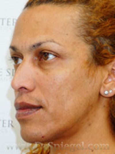 FFS Before & After Gallery - Patient 157140541 - Image 3