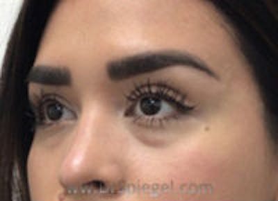 Tear Trough / Under Eye Fillers Before & After Gallery - Patient 157140542 - Image 3