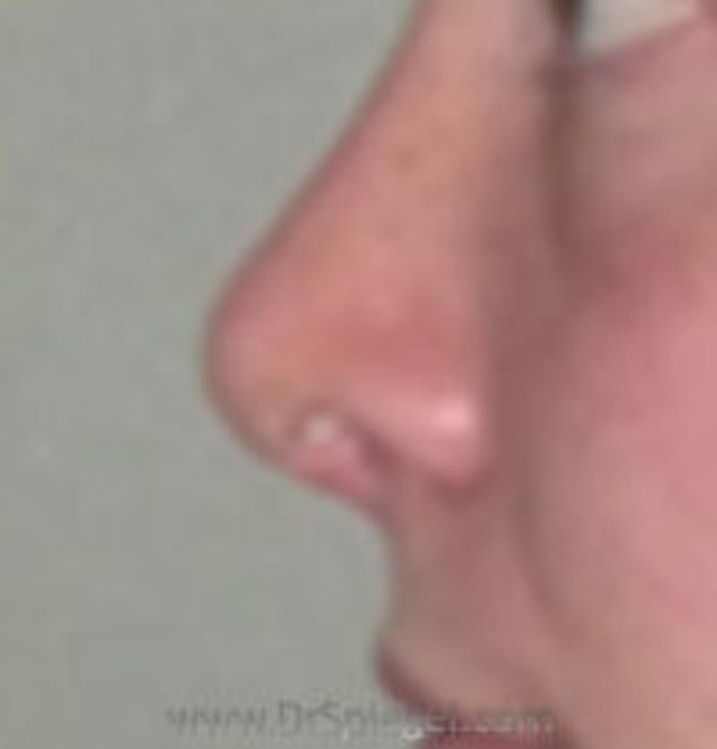 Rhinoplasty Before & After Gallery - Patient 157140539 - Image 2