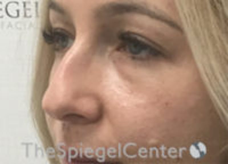 Non-Surgical Rhinoplasty / Nose Filler Before & After Gallery - Patient 157140545 - Image 3