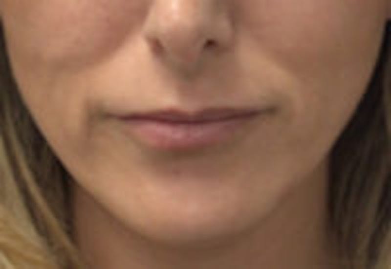 Lip Filler Before & After Gallery - Patient 157140548 - Image 3