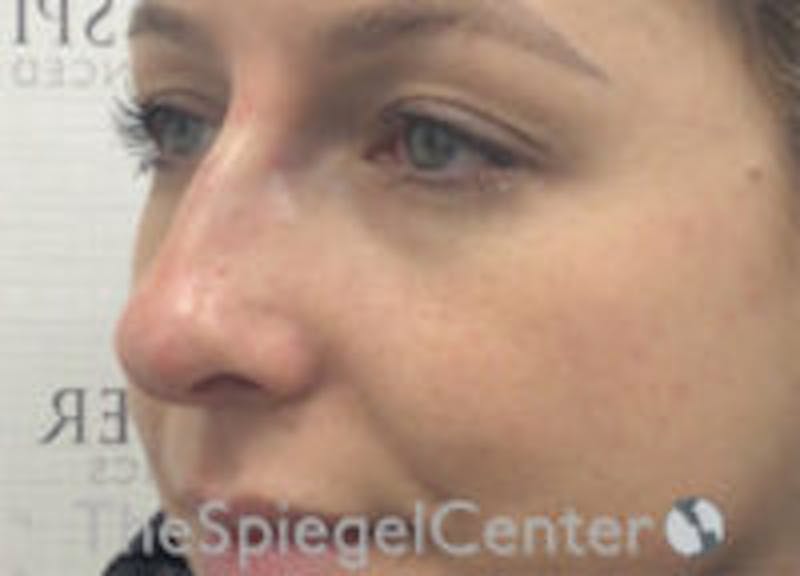 Non-Surgical Rhinoplasty / Nose Filler Before & After Gallery - Patient 157140545 - Image 4