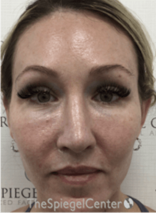 Morpheus8 Before & After Gallery - Patient 157140549 - Image 2