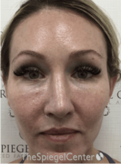Morpheus8 Before & After Gallery - Patient 157140549 - Image 2