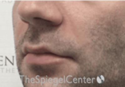 Nasolabial Fold Filler Before & After Gallery - Patient 157140546 - Image 3