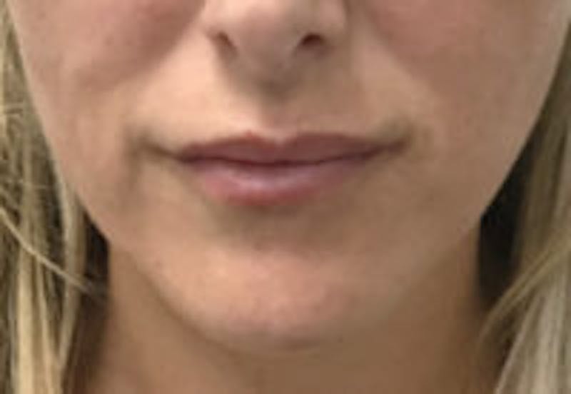 Lip Filler Before & After Gallery - Patient 157140548 - Image 4