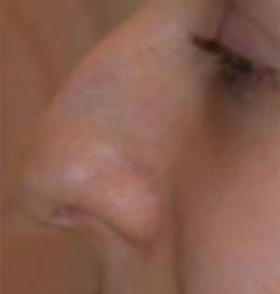 Rhinoplasty Before & After Gallery - Patient 157140547 - Image 1