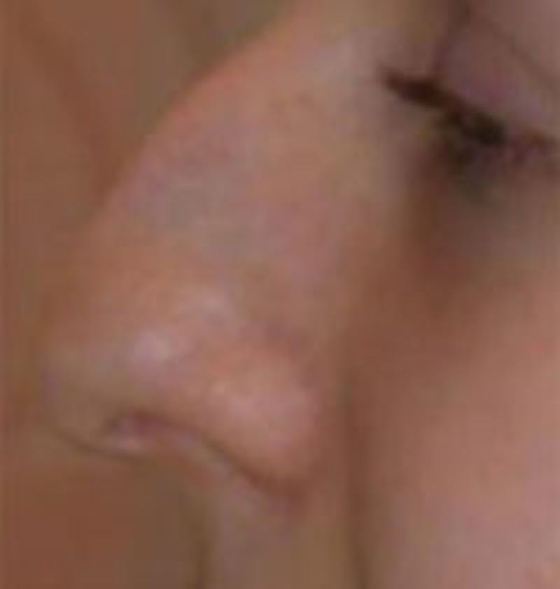 Rhinoplasty Before & After Gallery - Patient 157140547 - Image 1