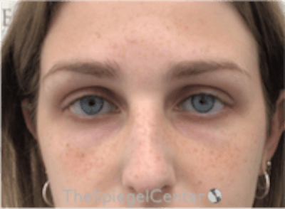 Upper Eyelid Filler Before & After Gallery - Patient 157140553 - Image 1