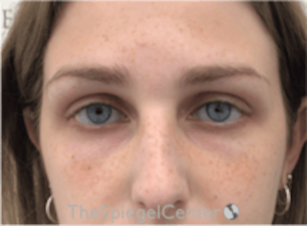 Tear Trough Filler