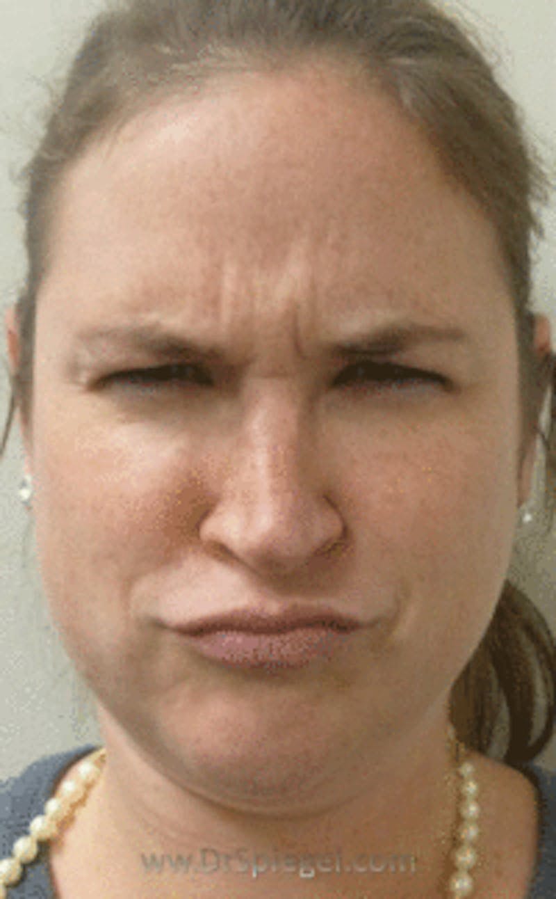 Botox / Dysport / Jeuveau / Xeomin Before & After Gallery - Patient 157140551 - Image 1