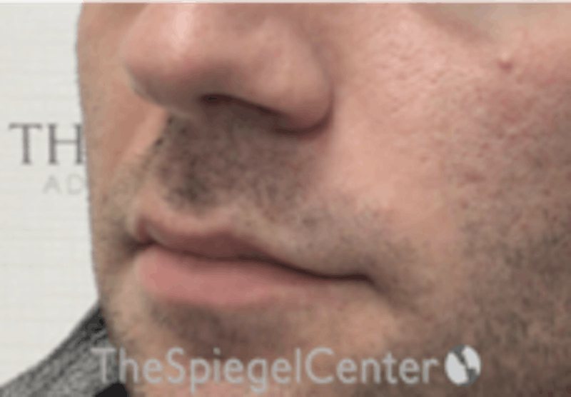 Nasolabial Fold Filler Before & After Gallery - Patient 157140546 - Image 4