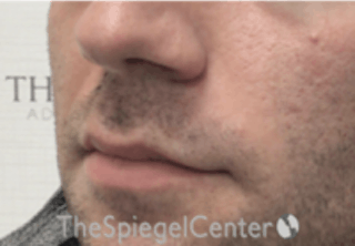 Nasolabial Fold Filler Before & After Gallery - Patient 157140546 - Image 4