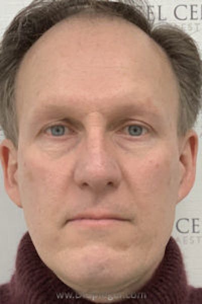 FFS Before & After Gallery - Patient 157140552 - Image 1