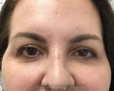 Temple Filler Before & After Gallery - Patient 157140550 - Image 1