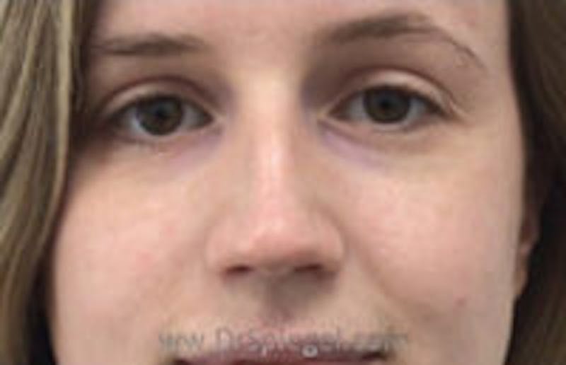 Non-Surgical Rhinoplasty / Nose Filler Before & After Gallery - Patient 157140556 - Image 1