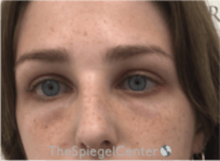 Upper Eyelid Filler Before & After Gallery - Patient 157140553 - Image 2