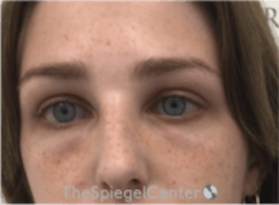 Upper Eyelid Filler Before & After Gallery - Patient 157140553 - Image 2