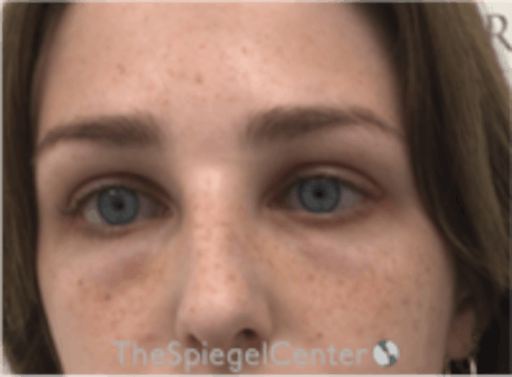 Tear Trough Filler
