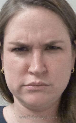 Botox / Dysport / Jeuveau / Xeomin Before & After Gallery - Patient 157140551 - Image 2