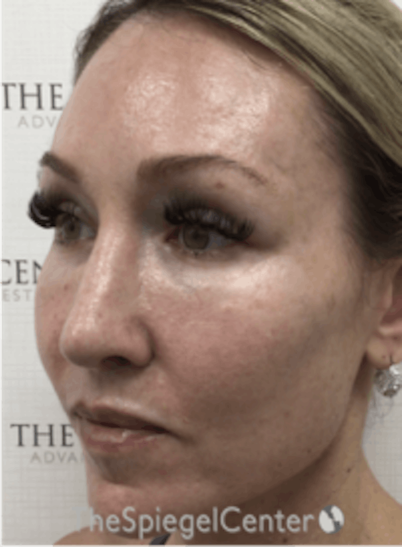 Morpheus8 Before & After Gallery - Patient 157140549 - Image 4