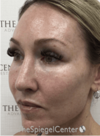 Morpheus8 Before & After Gallery - Patient 157140549 - Image 4