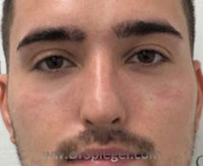 Tear Trough / Under Eye Fillers Before & After Gallery - Patient 157140555 - Image 2