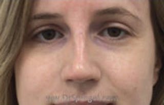 Non-Surgical Rhinoplasty / Nose Filler Before & After Gallery - Patient 157140556 - Image 2