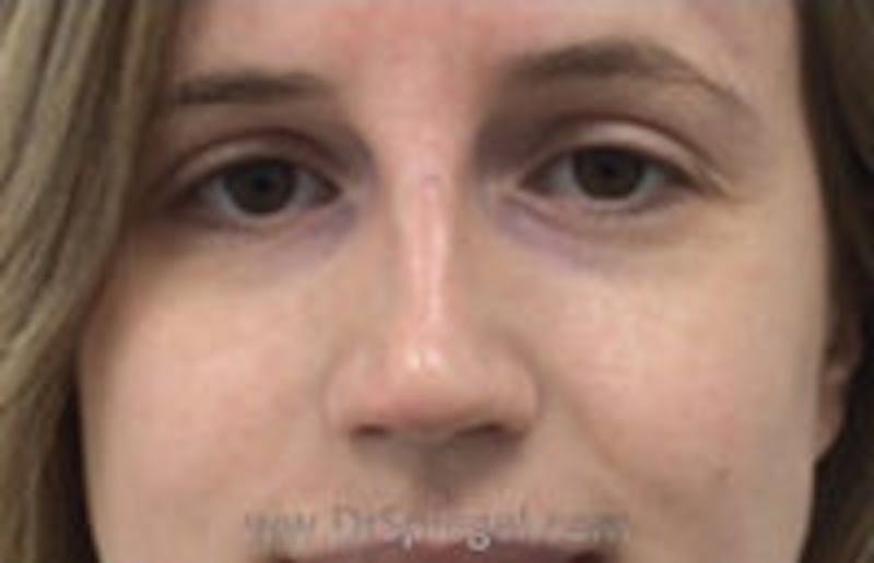 Non-Surgical Rhinoplasty / Nose Filler Before & After Gallery - Patient 157140556 - Image 2