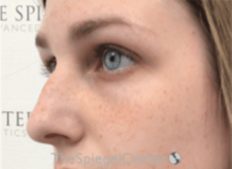 Upper Eyelid Filler Before & After Gallery - Patient 157140553 - Image 3
