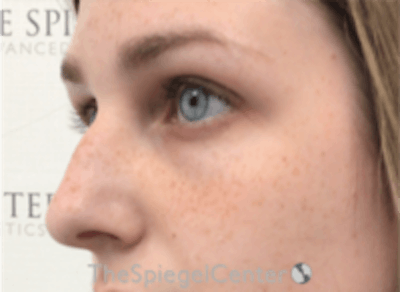 Upper Eyelid Filler Before & After Gallery - Patient 157140553 - Image 3