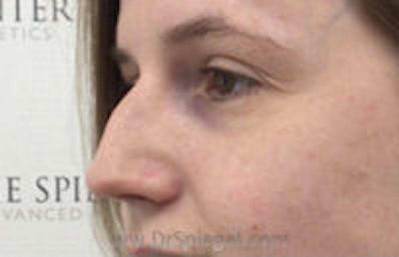 Non-Surgical Rhinoplasty / Nose Filler Before & After Gallery - Patient 157140556 - Image 3