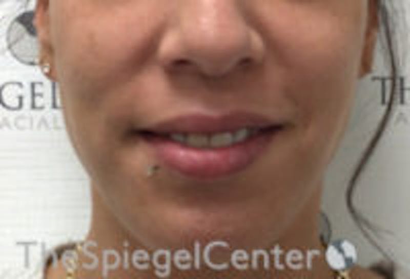 Lip Filler Before & After Gallery - Patient 157140563 - Image 1