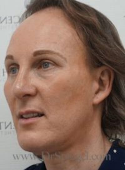 FFS Before & After Gallery - Patient 157140552 - Image 4