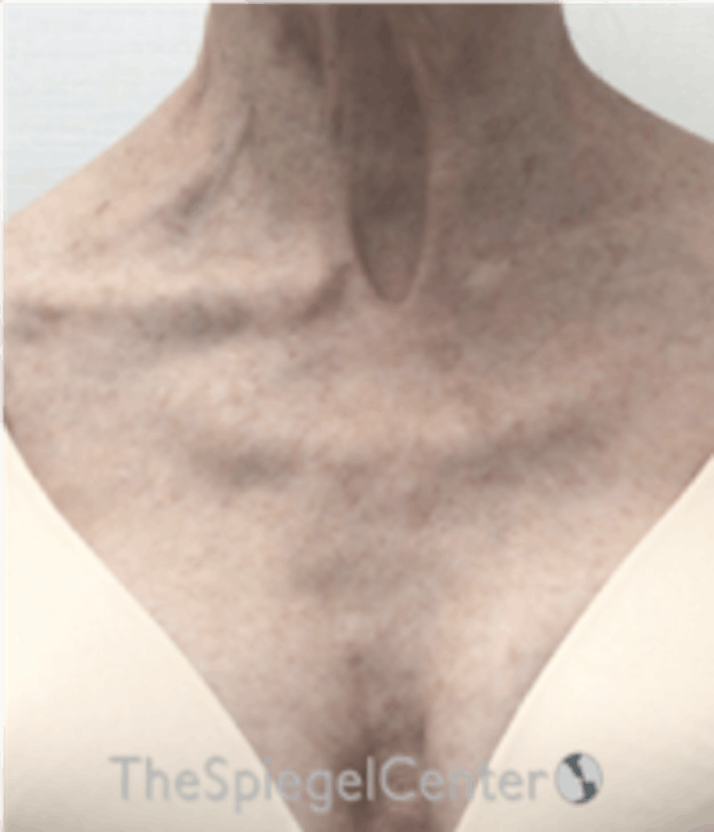 Morpheus8 Before & After Gallery - Patient 157140561 - Image 1