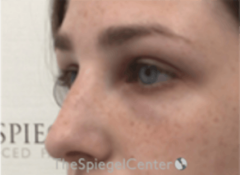 Upper Eyelid Filler Before & After Gallery - Patient 157140553 - Image 4