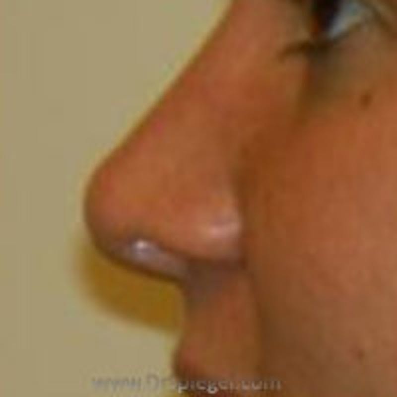 Rhinoplasty Before & After Gallery - Patient 157140554 - Image 2