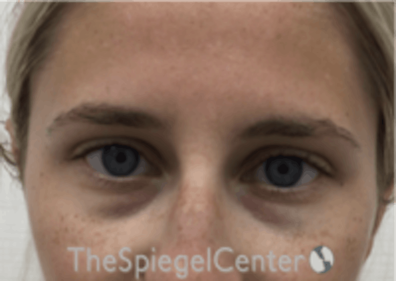 Temple Filler Before & After Gallery - Patient 157140557 - Image 1