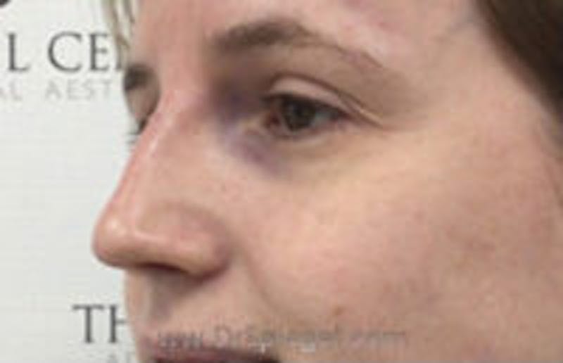 Non-Surgical Rhinoplasty / Nose Filler Before & After Gallery - Patient 157140556 - Image 4
