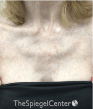 Morpheus8 Before & After Gallery - Patient 157140561 - Image 2