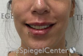 Lip Filler Before & After Gallery - Patient 157140563 - Image 2