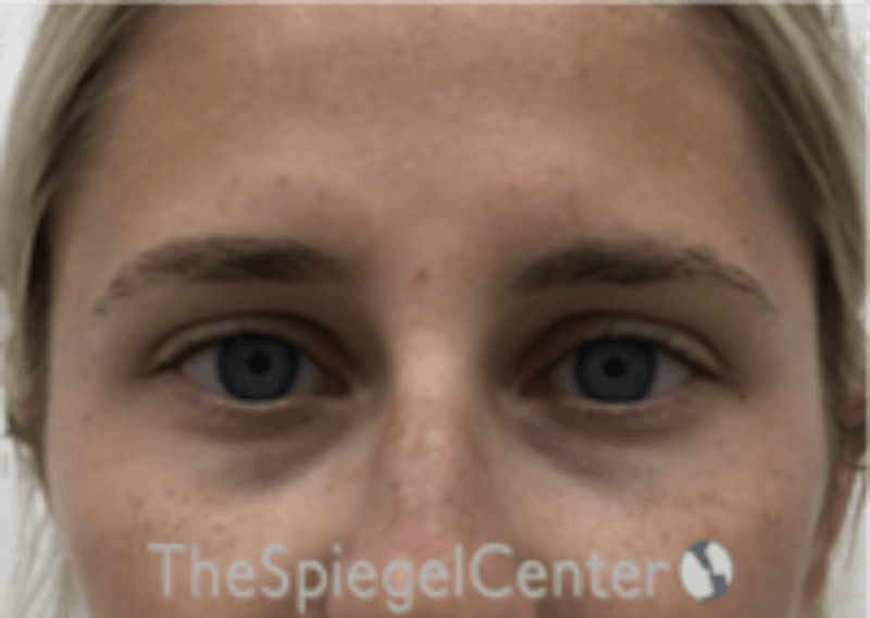 Temple Filler Before & After Gallery - Patient 157140557 - Image 2
