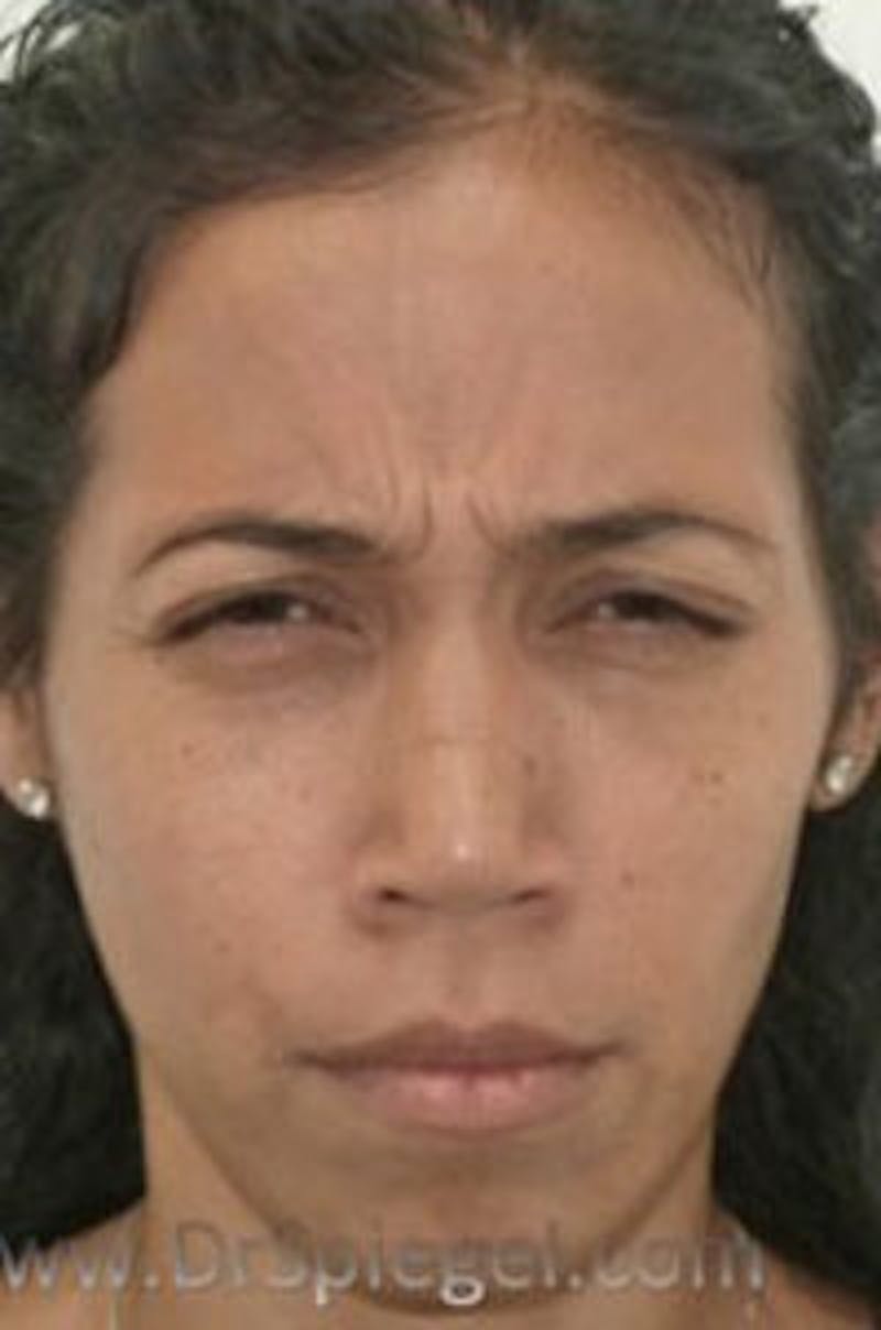 Botox / Dysport / Jeuveau / Xeomin Before & After Gallery - Patient 157140565 - Image 1